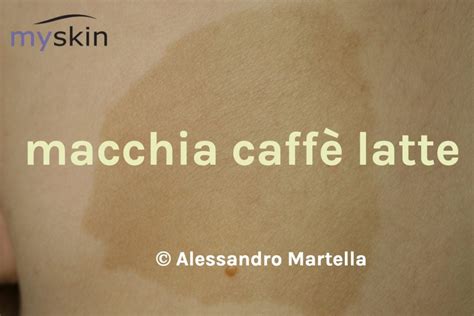 bambino con macchie caffè latte