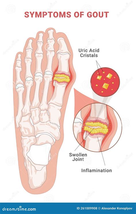 Illustrazione anatomica dell'alluce con depositi di cristalli di acido urico