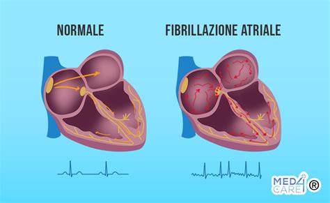 Paziente anziano con fibrillazione atriale