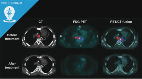 Schema comparativo tra TAC e PET-TAC per la diagnosi del tumore polmonare