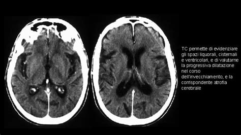 Immagine di TAC encefalo con cisti di Toxoplasma gondii
