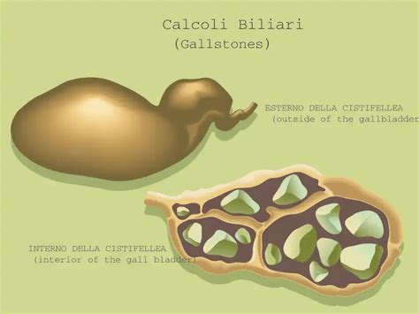 Calcoli biliari all'interno di una cistifellea