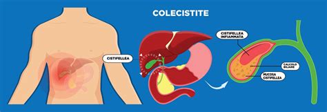 Localizzazione del dolore nella colecistite acuta