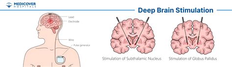 Immagine di un dispositivo di stimolazione cerebrale profonda