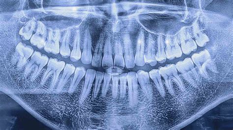 Radiografia dentale di una cavia che mostra la malocclusione