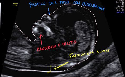 Ecografia fetale durante la misurazione della translucenza nucale