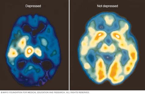 Schematic representation of brain activity in depression