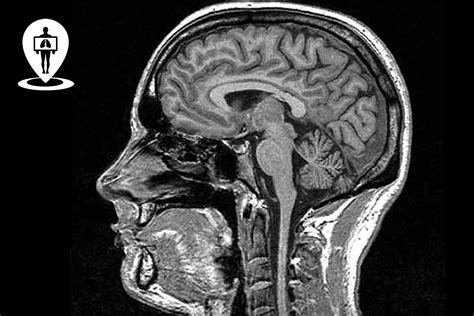 Immagine di risonanza magnetica cerebrale con sovrapposizione di dati di attivazione