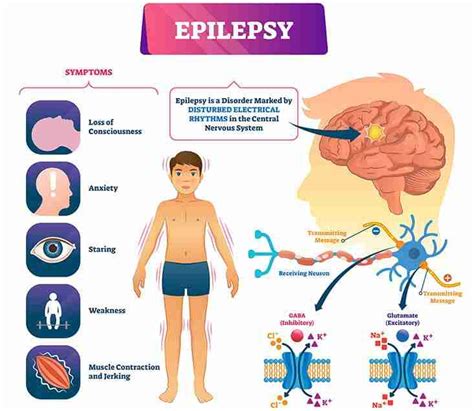 Diagramma che illustra la correlazione tra epilessia e disturbi d'ansia/depressione