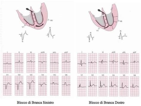 Elettrocardiogramma (ECG) normale e con blocco di branca sinistra