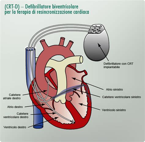 Schema di funzionamento di un pacemaker biventricolare per la CRT
