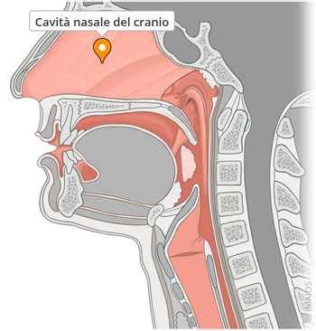 Schema di una cisti vicino alla cavità nasale