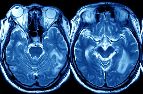 Immagine di una Risonanza Magnetica cerebrale che mostra aree di atrofia tipiche della demenza