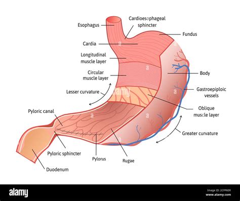 Illustrazione dello stomaco umano con evidenziate le lesioni della mucosa