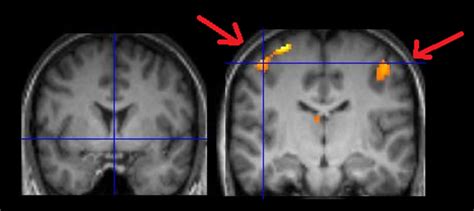 Immagine di una scansione fMRI che mostra l'attivazione cerebrale durante un compito cognitivo