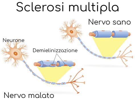 Schema della demielinizzazione nella sclerosi multipla