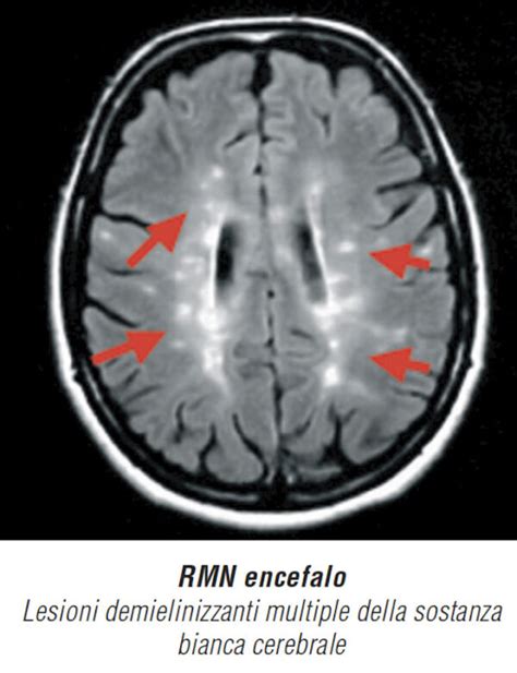Immagini di risonanza magnetica cerebrale che mostrano lesioni di sclerosi multipla