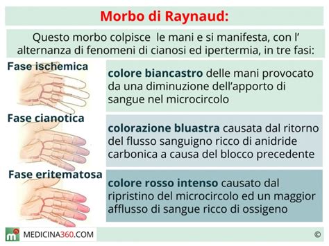 fasi del fenomeno di Raynaud sulle dita