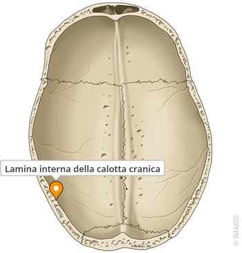 Calotta cranica utilizzata come ciotola