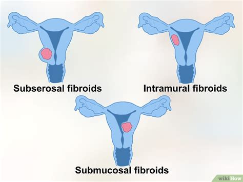 Utero con fibromi