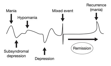 Diagramma che illustra lo spettro del disturbo bipolare, dalla mania alla depressione, con stati misti