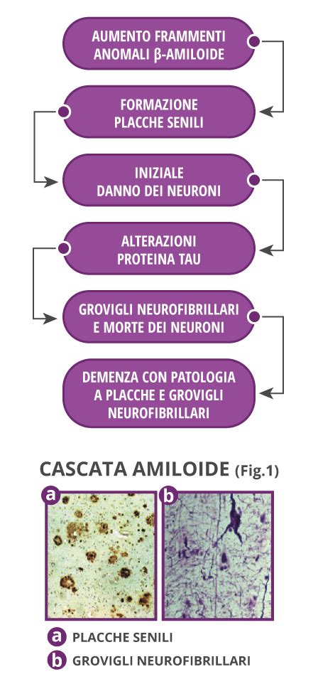 Diagramma della cascata amiloide nella malattia di Alzheimer