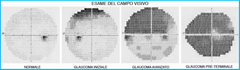 Illustrazione di un campo visivo con scotomi