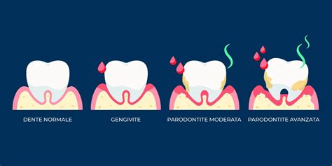 Diagramma che mostra le diverse fasi della parodontite, dall'infiammazione gengivale alla perdita ossea e dentale.