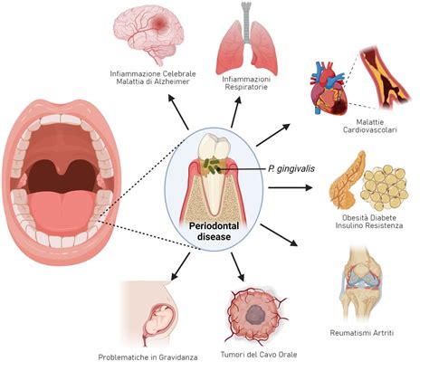 Infografica che illustra i batteri orali associati alla parodontite e il loro potenziale impatto sul cervello.