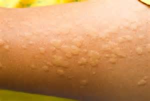 Primo piano di pelle arrossata con pomfi di orticaria