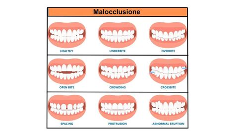 Diagramma che illustra la connessione tra malocclusione dentale e mal di schiena