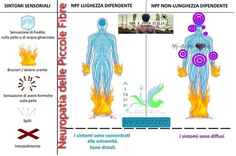 Schema della neuropatia delle piccole fibre