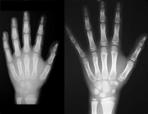 Radiografia della mano per l'età ossea