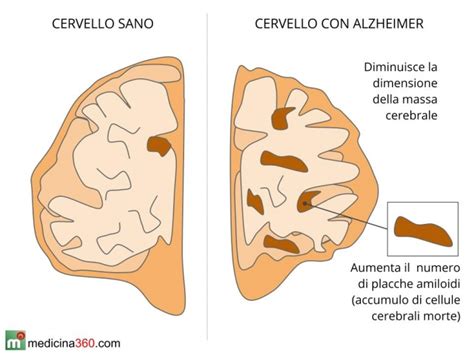 Diagramma che illustra le differenze tra Morbo di Alzheimer, Demenza Vascolare e Demenza da Corpi di Lewy