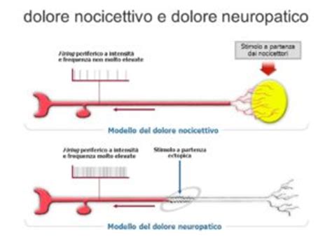 Schema che illustra le tre componenti principali del dolore: nocicettivo, neuropatico e nociplastico