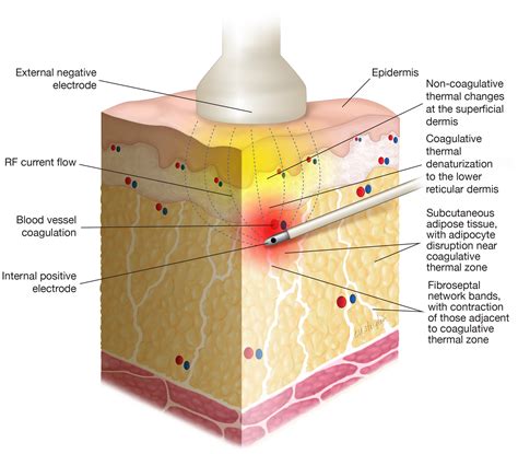 Schematic representation of bipolar radiofrequency energy penetrating the skin layers