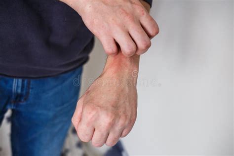 Immagine simbolica di mani che si grattano compulsivamente la pelle