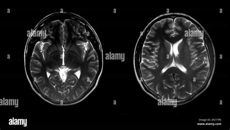 Immagine di una Risonanza Magnetica Cerebrale (MRI)